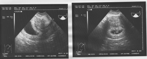echographie du ventre echographie du ventre